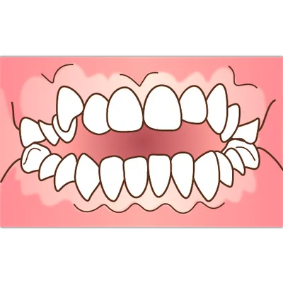 開咬（噛んだ時に前歯が咬み合わない状態）のイラスト