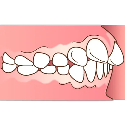 上顎前突（上の歯が飛び出ている出っ歯の状態）のイラスト
