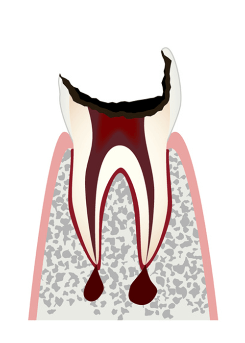 C4 むし歯が進行し大きく穴が開いている、もしくは歯が殆ど残っていない状態