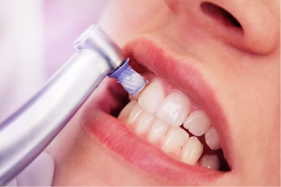 クリーニングと歯石除去の違い